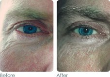 Wrinkles and fine lines
Before & After