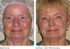 Glymed Plus Chocolate Resuce Mask 
Before & After 