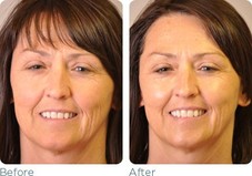 Glymend Plus Stem Cell Serum

Before & After